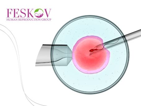 ICSI procedure: features and possibilities foto ICSI procedure: features and possibilities picture