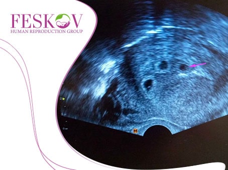 Triplets and Twins: The Likelihood of Multiple Births During Surrogacy foto Triplets and Twins: The Likelihood of Multiple Births During Surrogacy picture