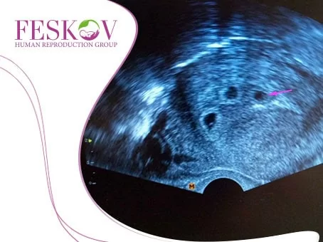 Triplets and Twins: The Likelihood of Multiple Births During Surrogacy foto Triplets and Twins: The Likelihood of Multiple Births During Surrogacy picture